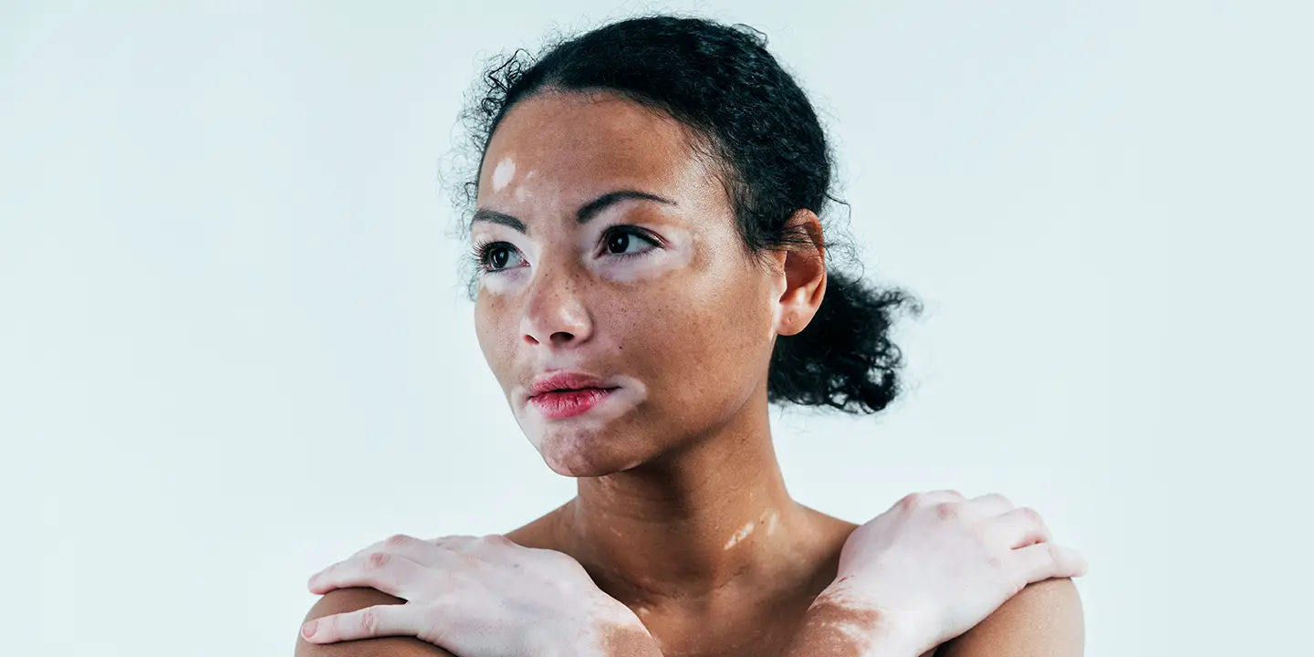 World Vitiligo Day 2023 Raise Awareness & Support for Vitiligo