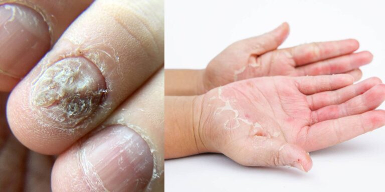 Candidiasis of the skin and nails: Symptoms, treatment, and prevention