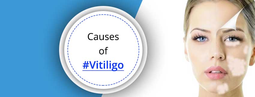Causes of Vitiligo  Symptoms Treatments White Spots on 